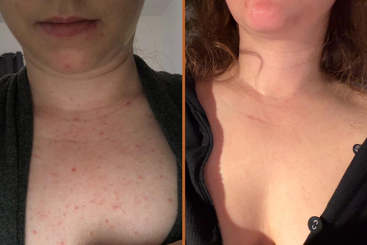 Brittany-before-after-Chest