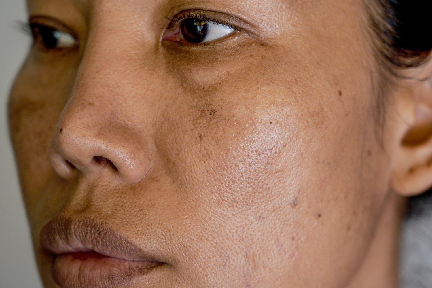 Close-up of facial dark spots and melasma