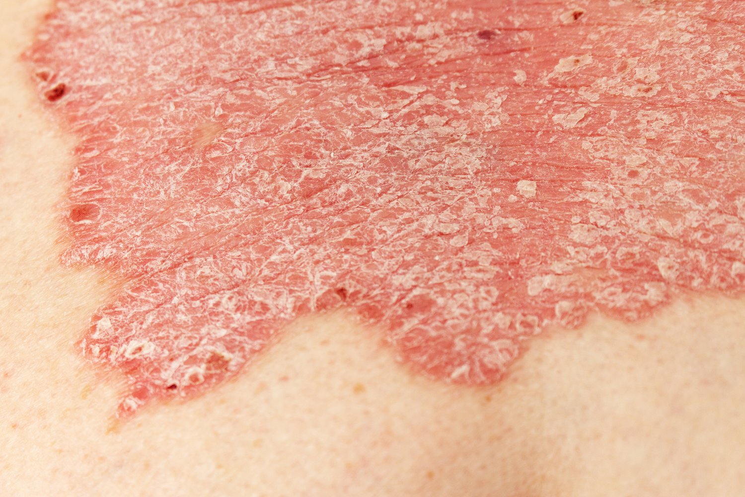 Close-up of psoriasis plaques on skin